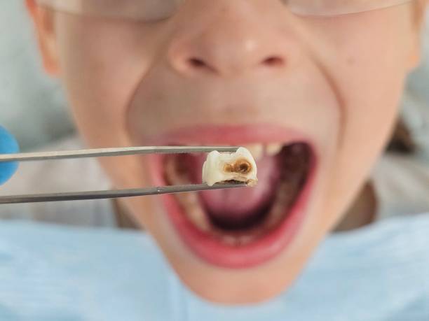 Best Knocked-Out Tooth (Avulsed Tooth) Treatment in Heron Bay, GA